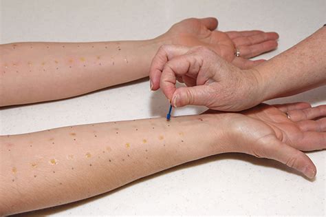 scratch test duration|scratch testing for allergies.